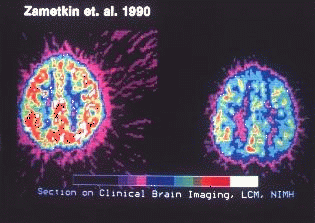  정상인(좌)과 주의력결핍 과다행동 장애가 있는 사람(오른쪽)의 뇌를 촬영한 사진 