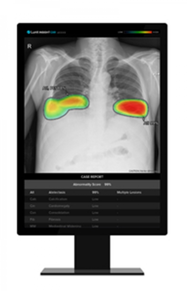 루닛의 AI 기반 흉부 X레이 영상분석 시스템 '루닛 인사이트 CXR'