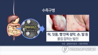 "작년의 2배" 수족구병 7주째 급확산…영유아 있다면 지금 당장 확인하세요