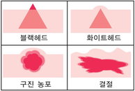 충동적인 ‘자가피부관리’, 오히려 여드름의 ‘적’