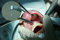 스케일링도 해결 못하는 잇몸세균, ‘레이저로 잡는다’