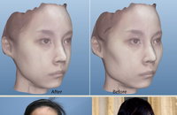 3D 가상성형 시스템으로 After 미리알기