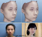3D 가상성형 시스템으로 After 미리알기