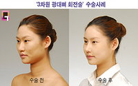 ‘잘못된 광대뼈 상식’, 성형전문의에게 듣는다