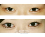 쌍꺼풀재수술, 성형수술 중 증가율 가장 커