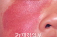 이달부터 '화염상모반' 치료비 부담 줄어든다