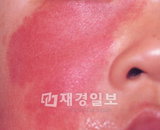 이달부터 '화염상모반' 치료비 부담 줄어든다