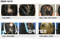 소홀히 여기다 큰 코 다치는 원형탈모