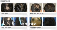 소홀히 여기다 큰 코 다치는 원형탈모