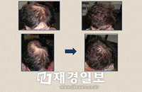 부모위한 효도선물로 '모발이식 수술' 인기