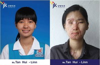 화상소녀 탄휘린, 한국서 웃음 되찾는다