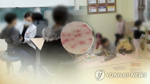 광주 아동 수두 감염 1.5배 급증 및 12주 차 환자 4.5배 폭증